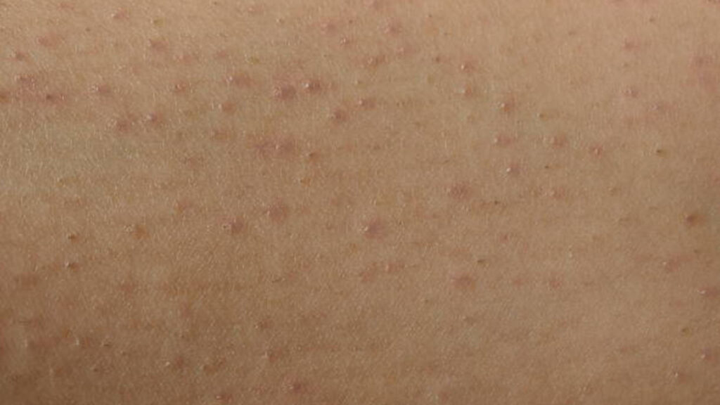 Razor bumps on skin after removing hair