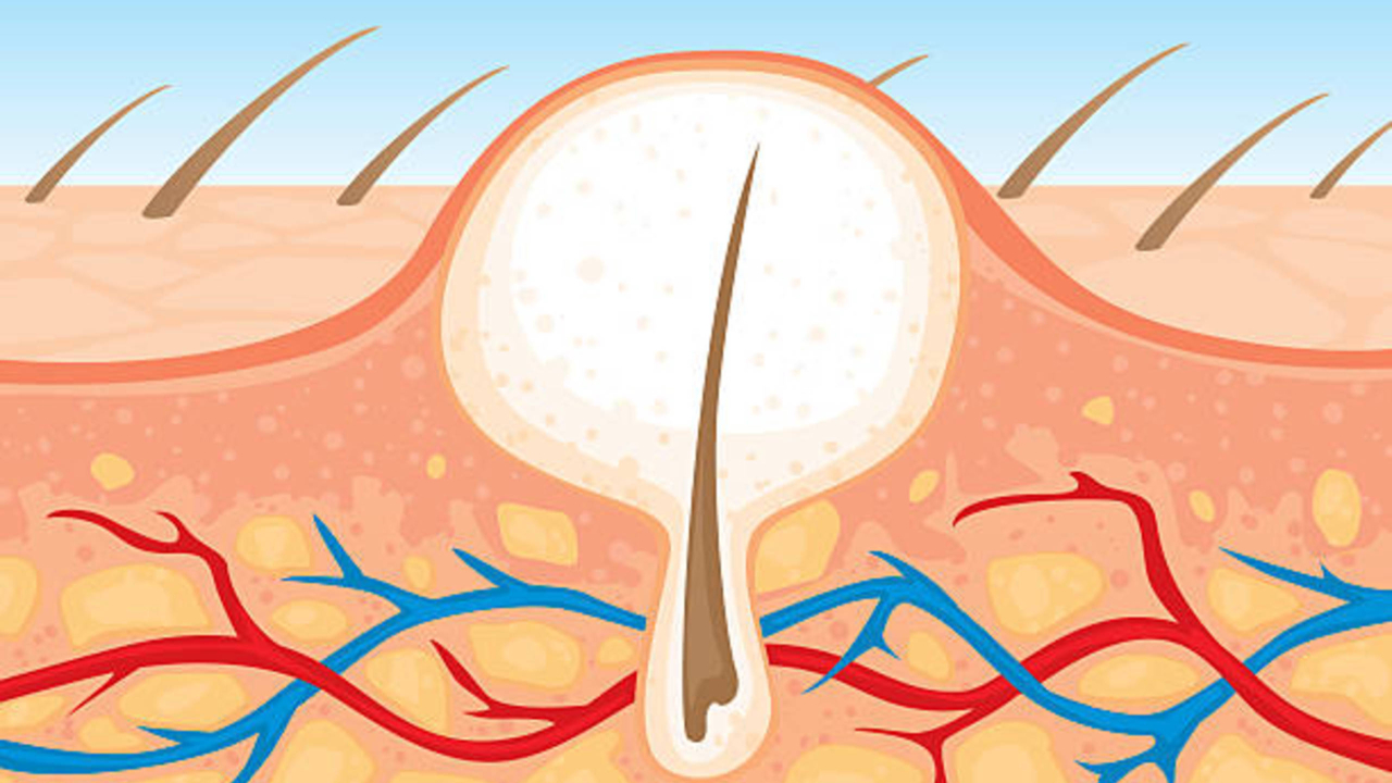 How Long for an Ingrown Hair Cyst to Go Away: Your Complete Guide