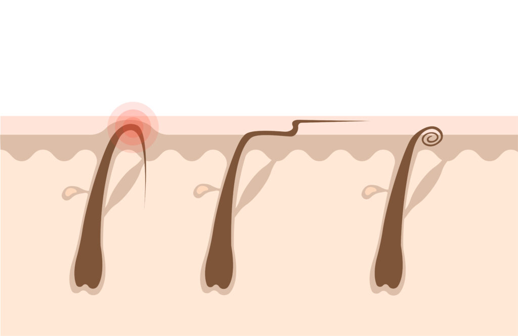 Types of ingrown hairs flat illustration. Cross section of the human skin with hair follicles. Hair removal concept.Can be used for topics like shaving, depilation, cosmetology