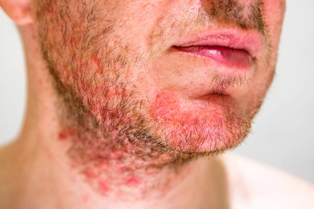 Detail of man's chin with seborrheic dermatitis in the beard area
