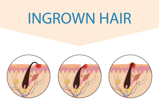 Varieties of ingrown hair. Medical scheme of hair ingrowth. Vector illustration isolated on white background for design and Internet.