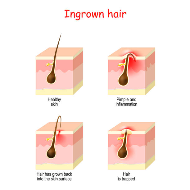 hair ingrown or has grown back into the skin surface after shaving, cream or epilation (waxing), or hair removal. Different Types of Ingrown: From Pimple and Inflammation to trapped. structure of the skin with hair follicle. vector illustration.