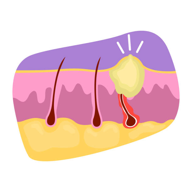 Pimple with ingrown hair 2D vector isolated illustration. Swollen bump flat sticker on cartoon background. Cyst treatment. Skin irritation colourful scene for mobile, website, presentation