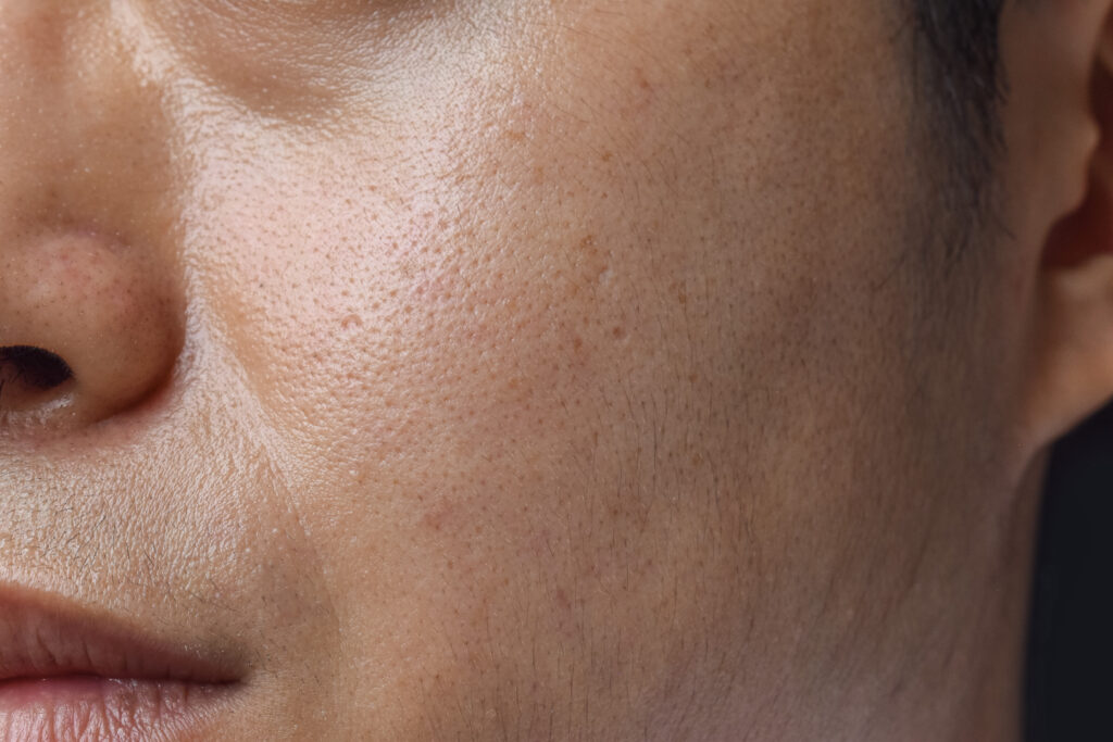 Fair skin with wide pores in face of Southeast Asian, Myanmar or Korean adult young man.