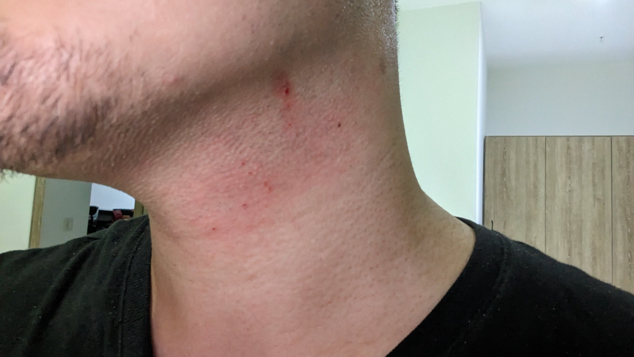 How Long to Wait to Shave After Razor Burn?