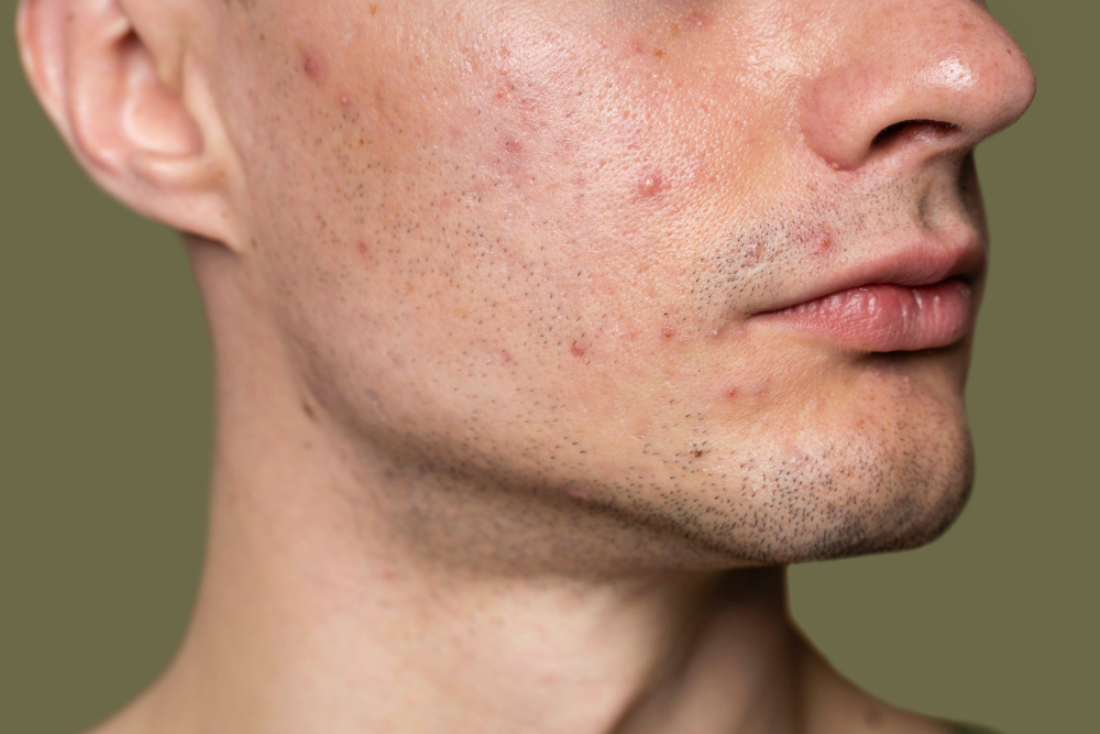 The Connection Between Shaving and Acne: How to Shave Without Causing Breakouts